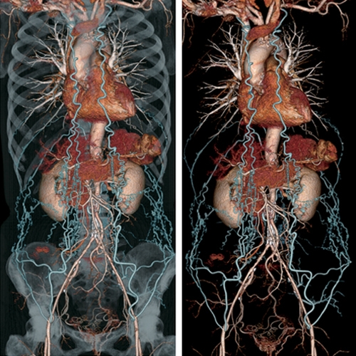 Comparação Angiotomografia e Angioressonância
