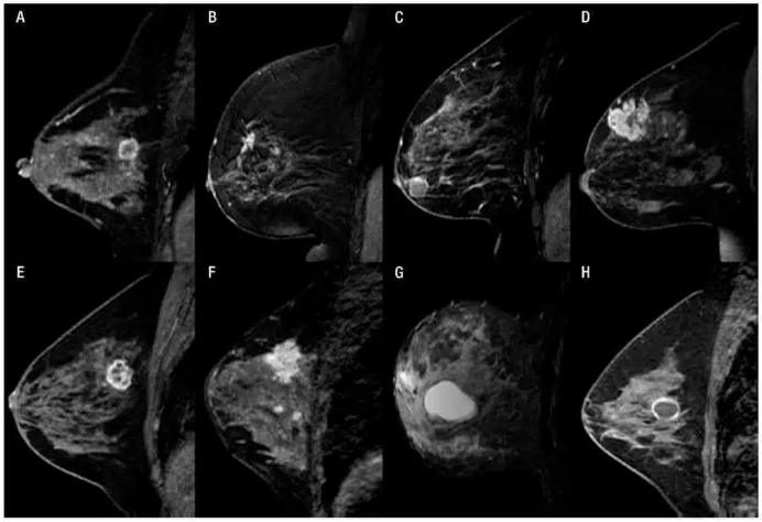 Câncer de Mama - Mamografia, Ultrassom, RM