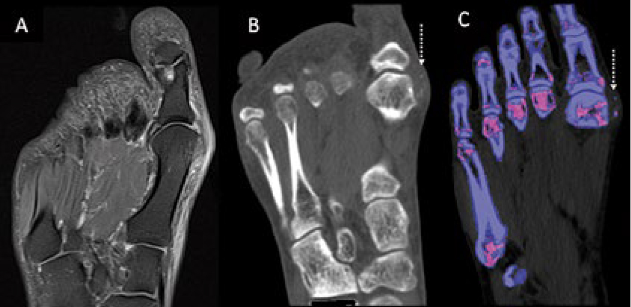 Tomografia por Dupla Energia
