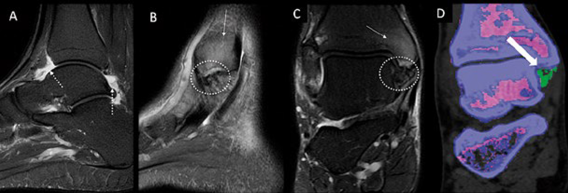 Tomografia por Dupla Energia