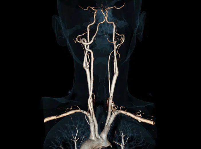 Tomografia por Dupla Energia