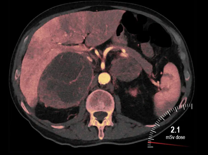 Tomografia por Dupla Energia