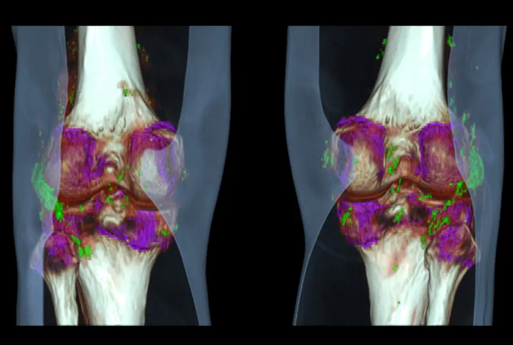 Tomografia por Dupla Energia