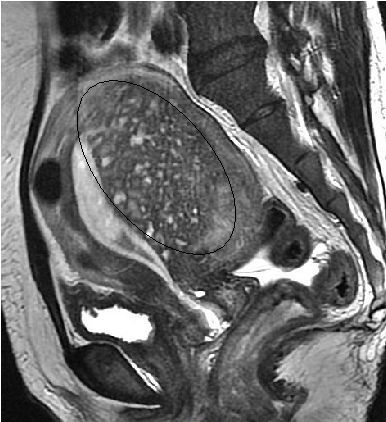 Ressonância Magnética e Adenomiose