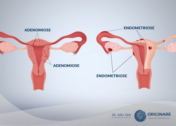 Ressonância Magnética e Adenomiose