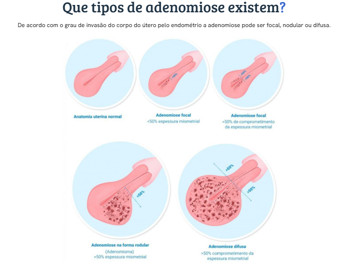 Ressonância Magnética e Adenomiose