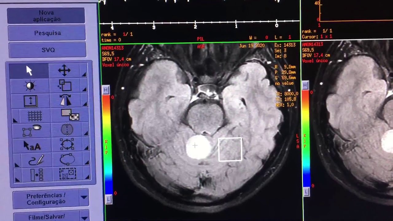 Espectroscopia por RM