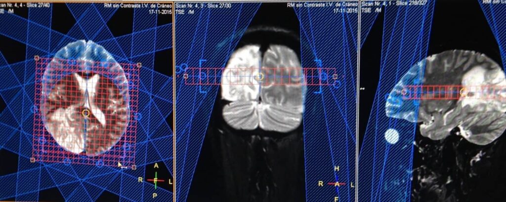 Espectroscopia por RM