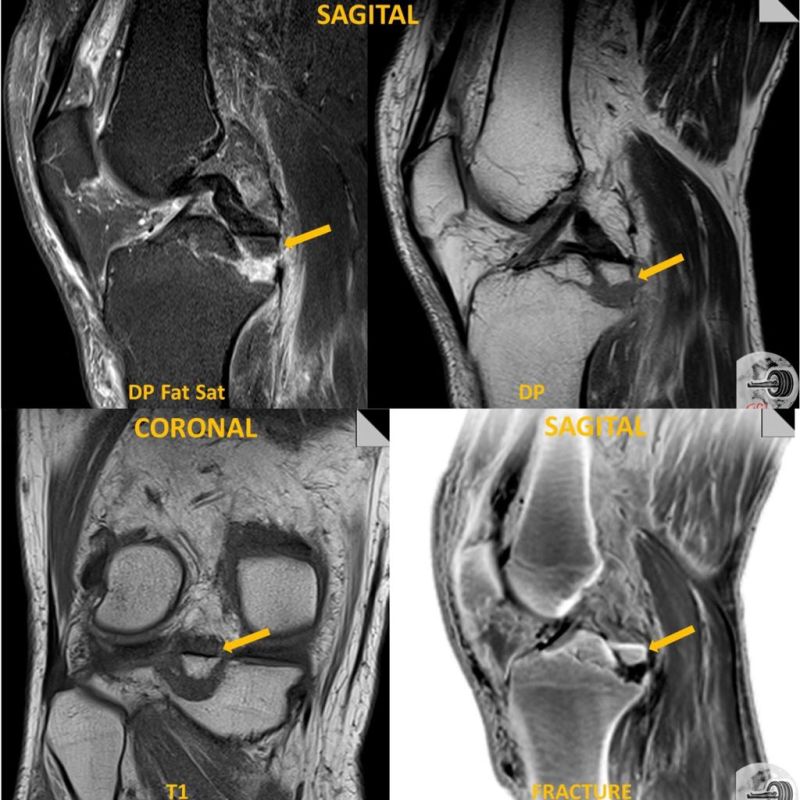 Imagem de alta resolução de osso na Ressonância Magnética