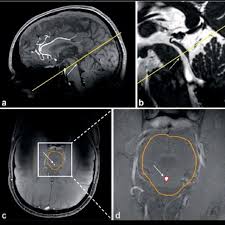Estudo de Fluxo Liquórico na RM