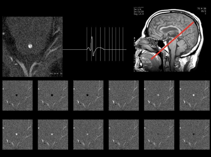 Estudo de Fluxo Liquórico na RM