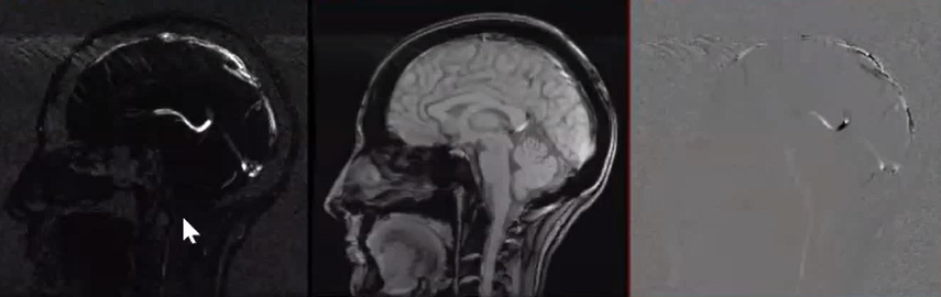 Estudo de Fluxo Liquórico na RM
