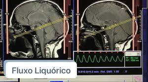 Estudo de Fluxo Liquórico na RM