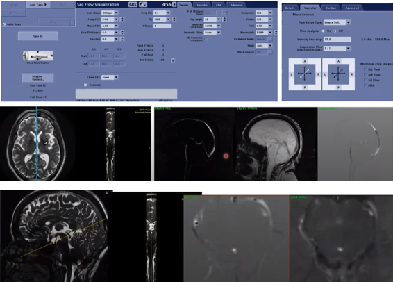 Estudo de Fluxo Liquórico na RM