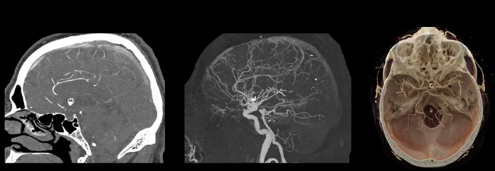 Ressonância Magnética e Adenomiose