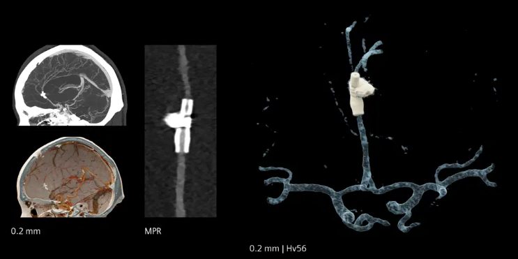 Ressonância Magnética e Adenomiose