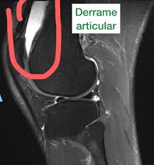 Ressonância Magnética em Lesões Esportivas