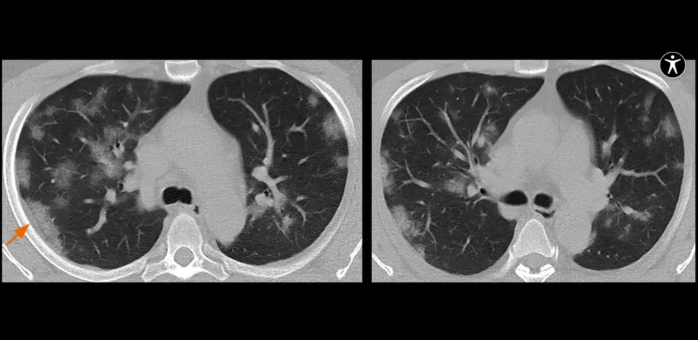Pulmão visto em tomografia