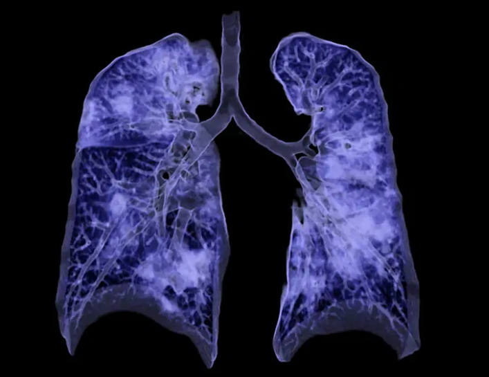 Pulmão visto em tomografia