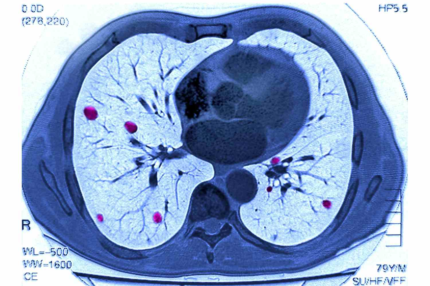 Pulmão visto em tomografia