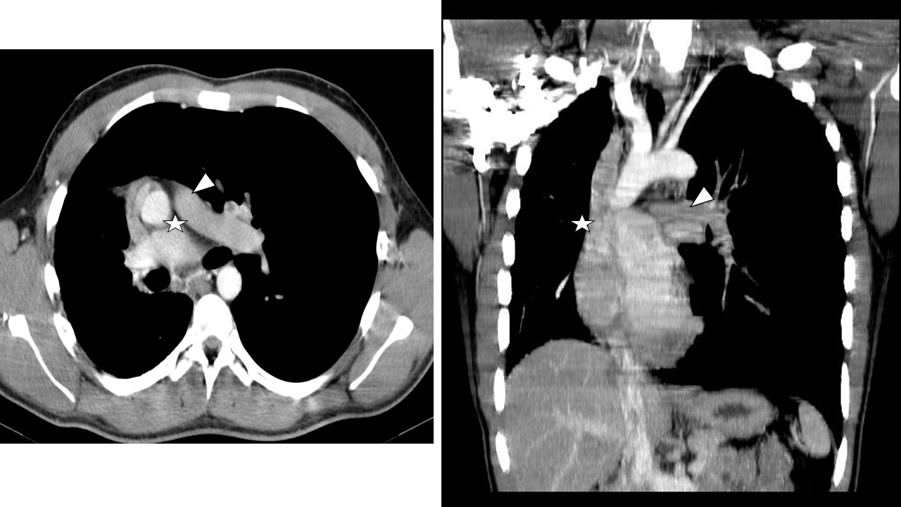 Pulmão visto em tomografia