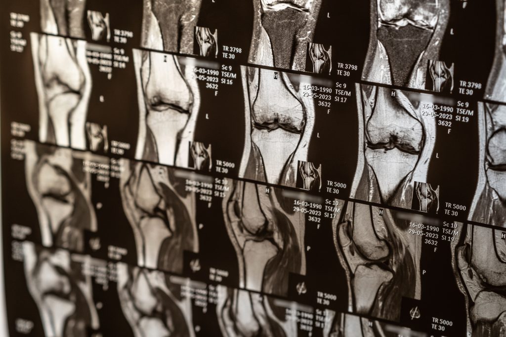 Ressonância Magnética em Lesões Esportivas