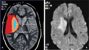 Identificação de Sangue na Ressonância Magnética