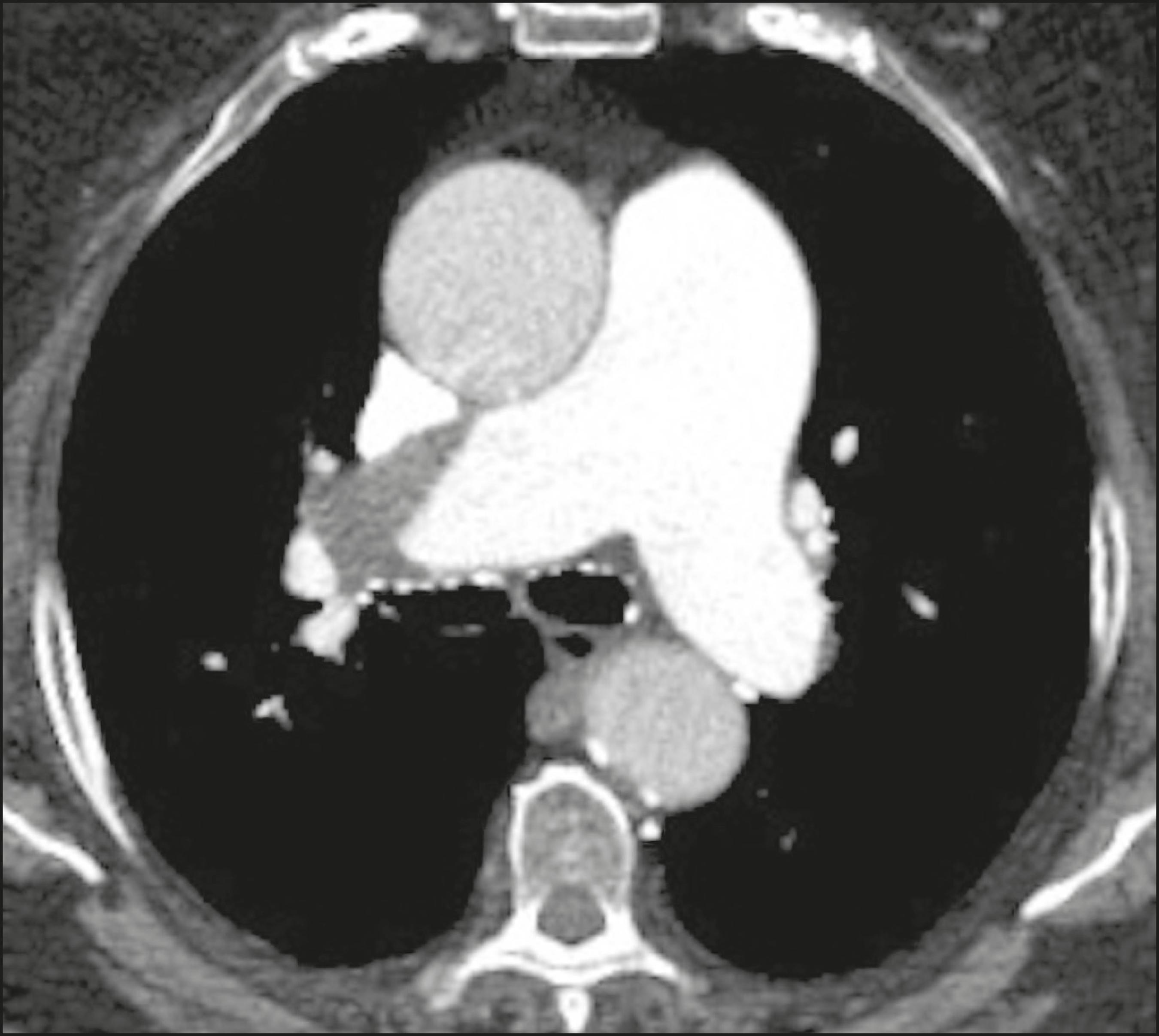 Tomografia Computadorizada para TEP