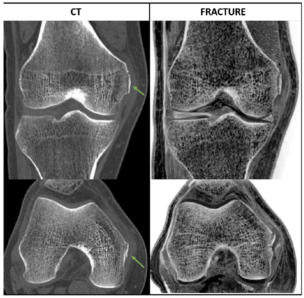 Detalhe ósseo com Técnica FRACTURE na RM