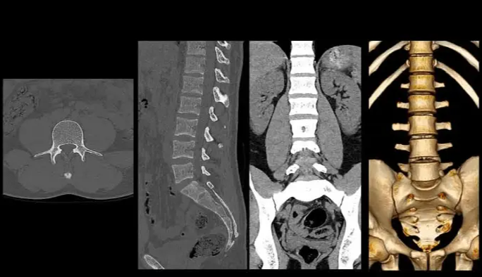 Tomografia com reconstrução 3D