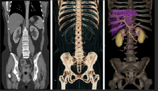 Exemplo de reconstrução volumétrica