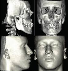 Tomografia 3D Reconstruída